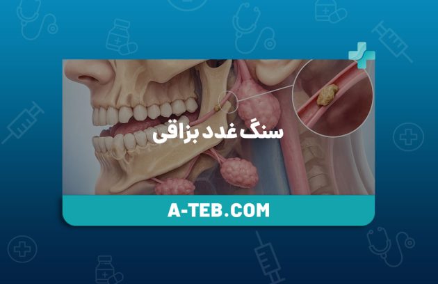 سنگ غدد بزاقی