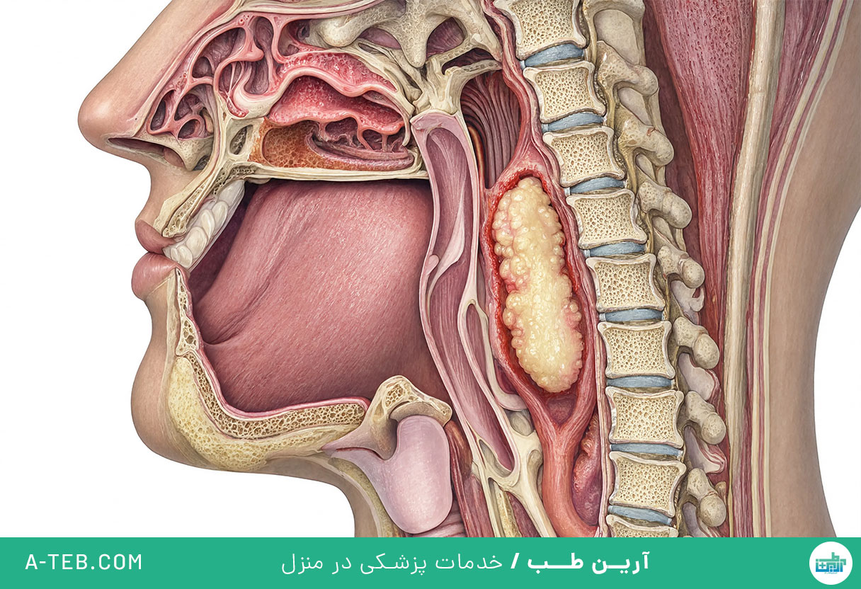 آبسه پشت حلق