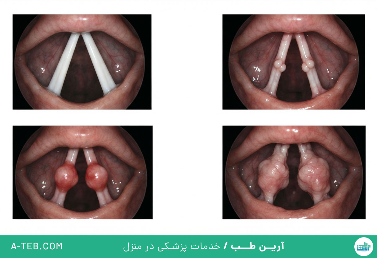 ندول حنجره