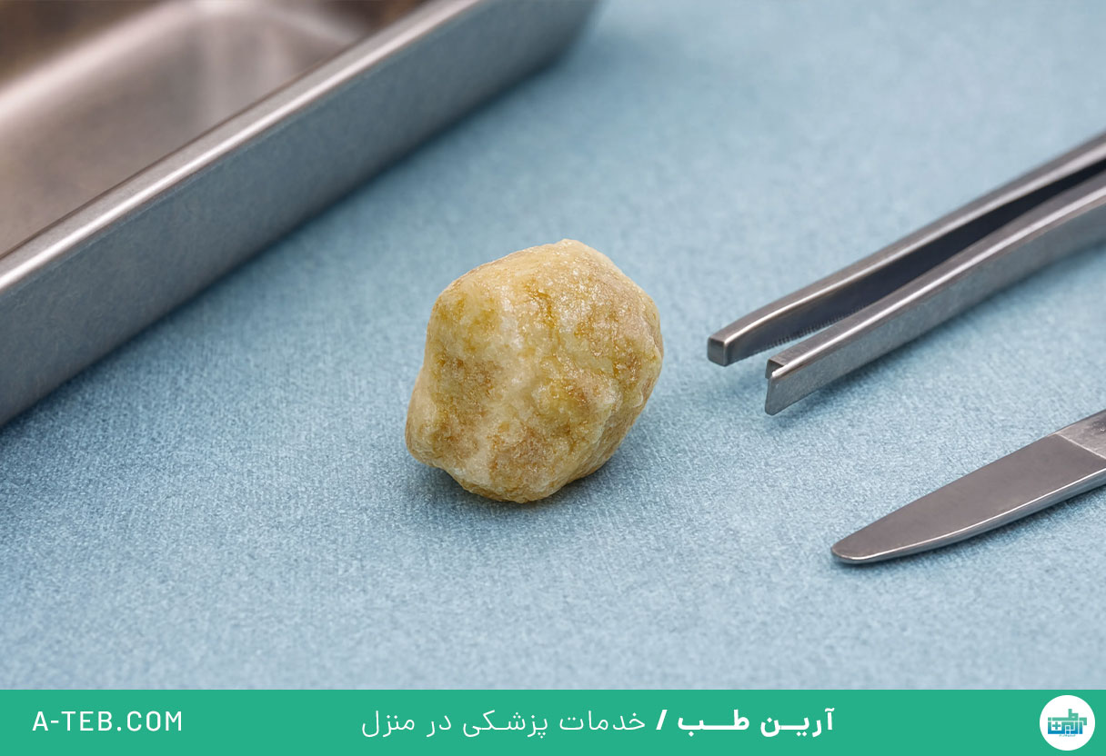 سنگ غدد بزاقی