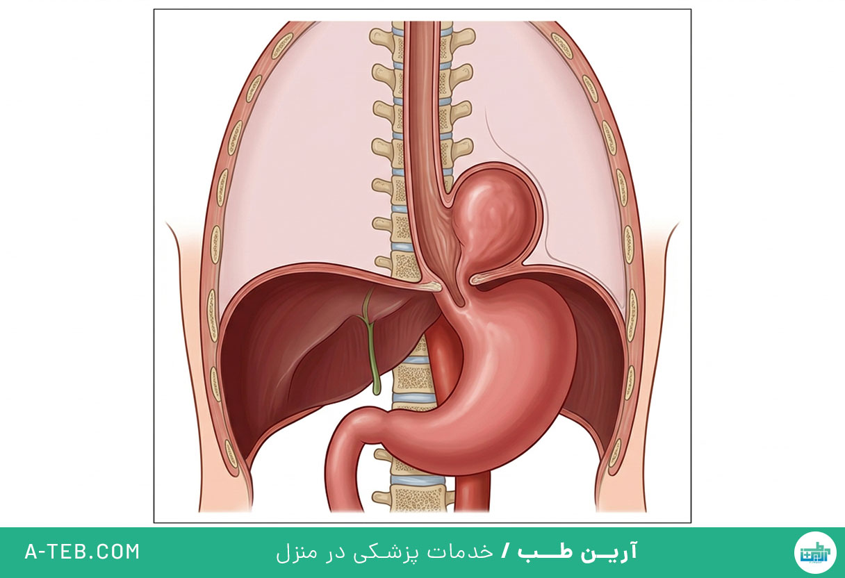 فتق هیاتال