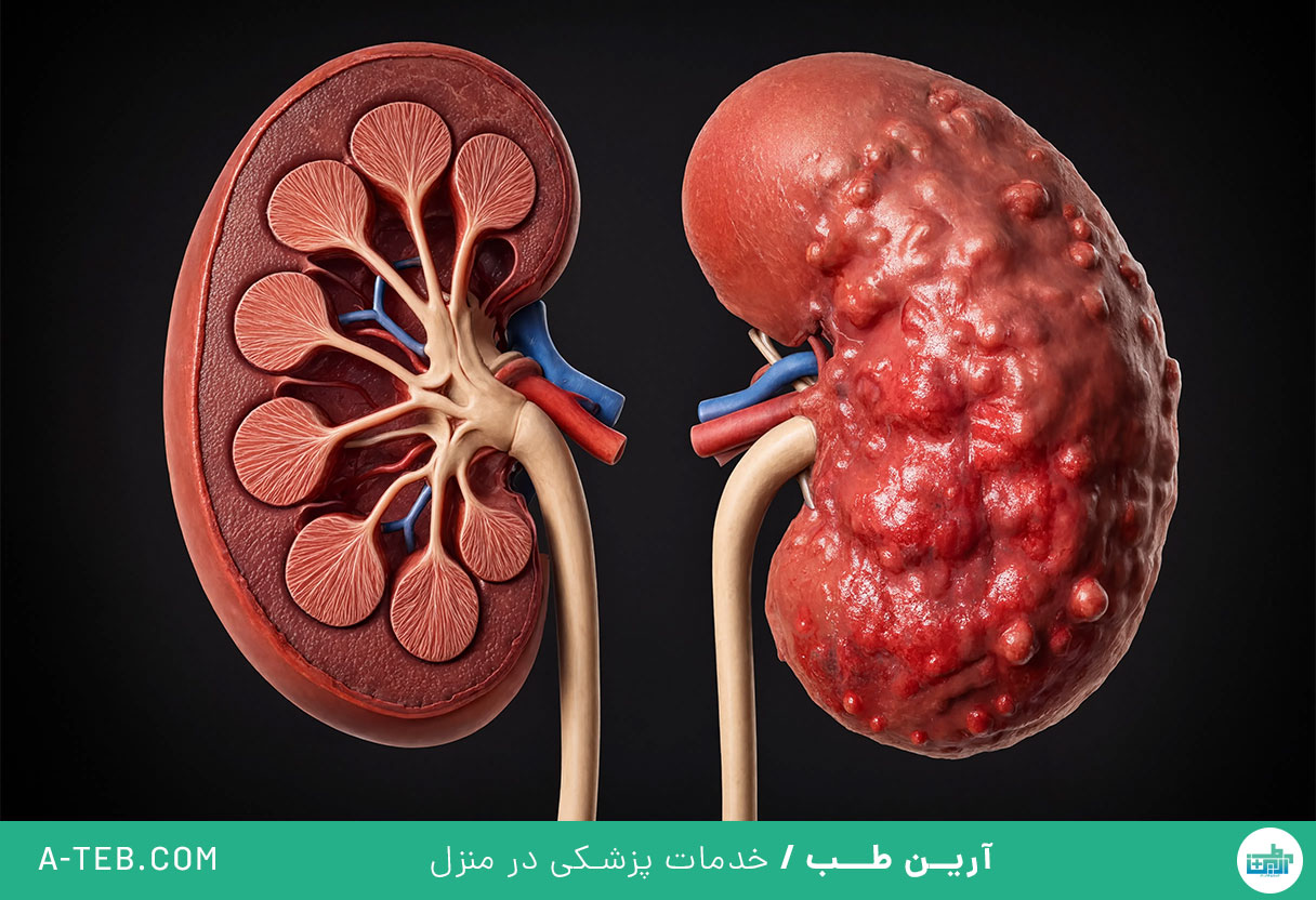 التهاب کلیه
