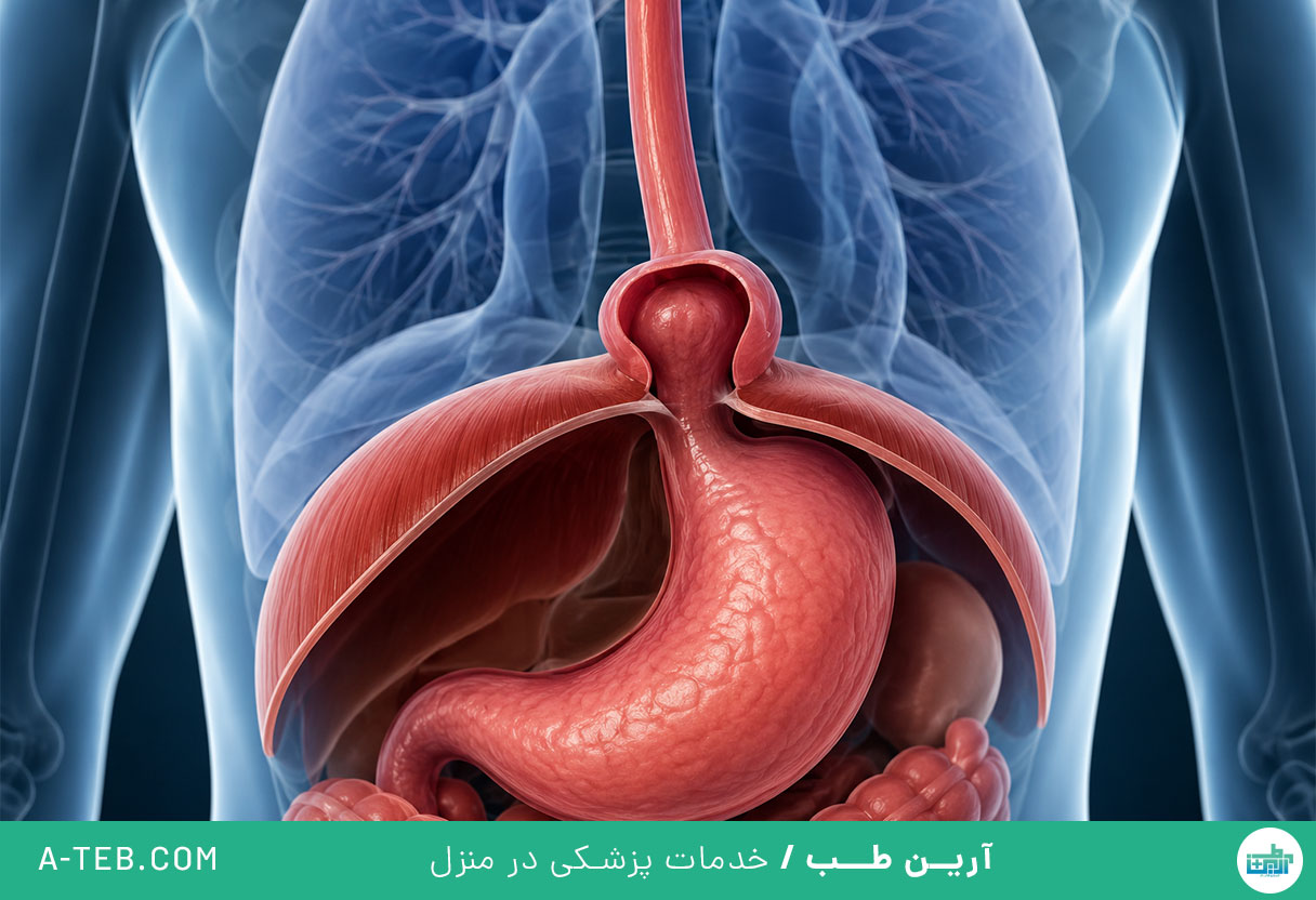 فتق هیاتال