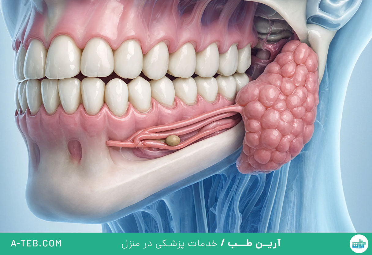 سنگ غدد بزاقی