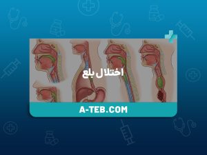 اختلال بلع