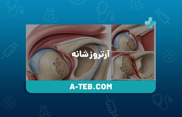 آرتروز شانه
