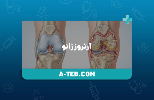 آرتروز زانو