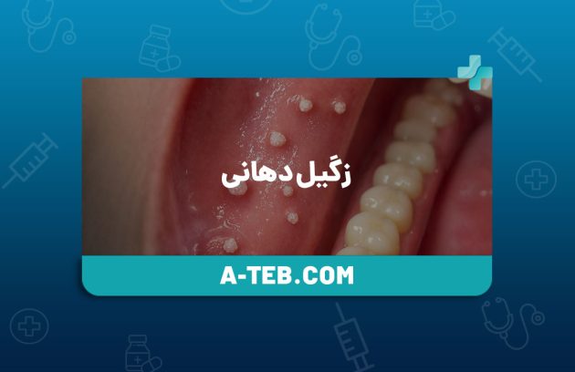 زگیل دهانی