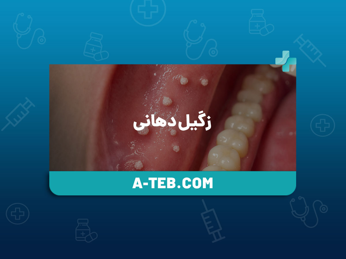 زگیل دهانی