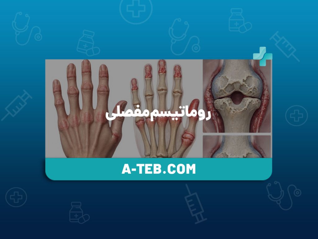 روماتیسم مفصلی