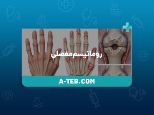 روماتیسم مفصلی