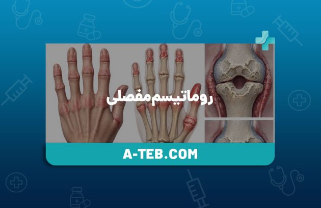 روماتیسم مفصلی