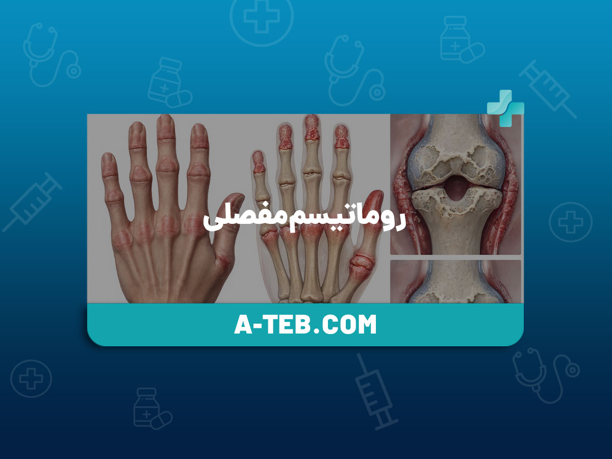 روماتیسم مفصلی