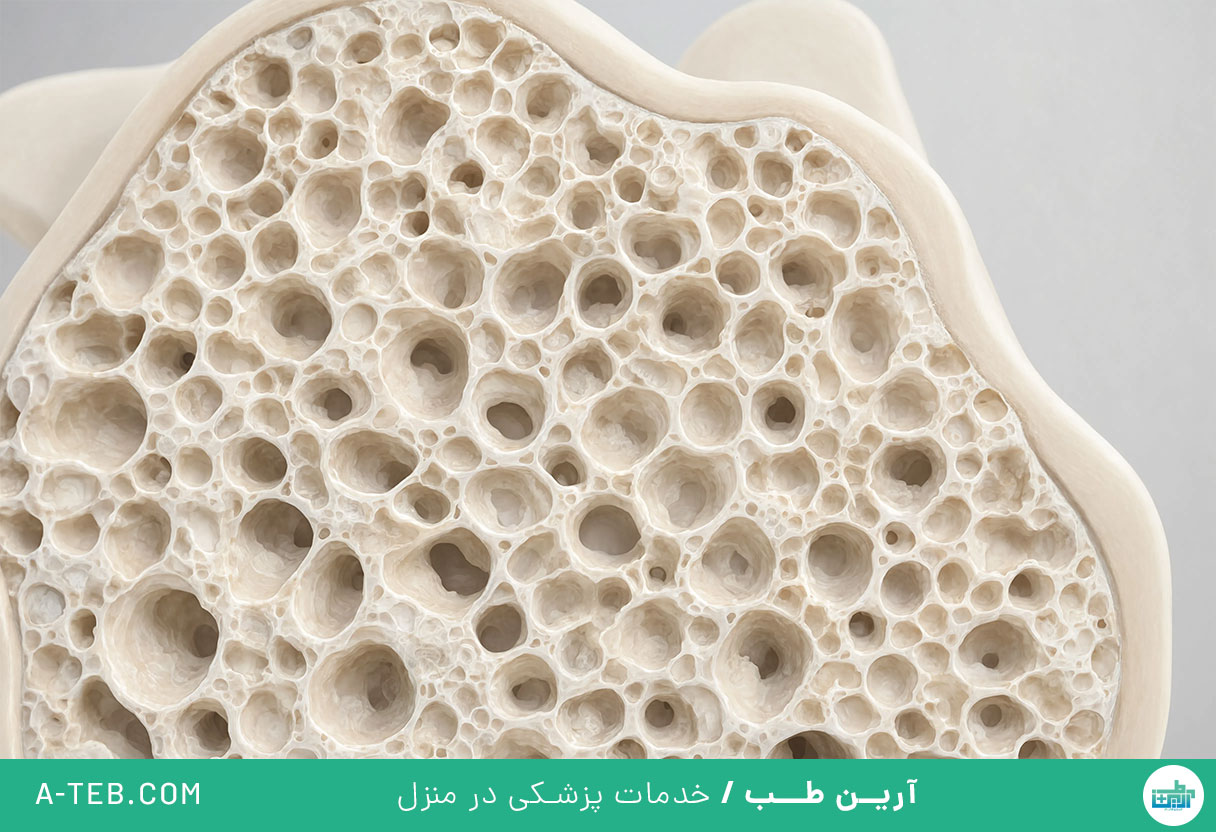 استئوپنی