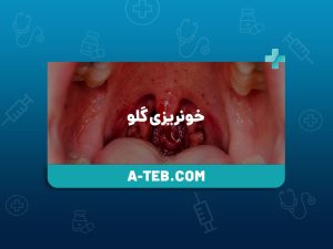 خونریزی گلو