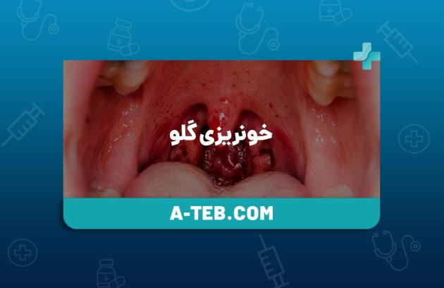 خونریزی گلو