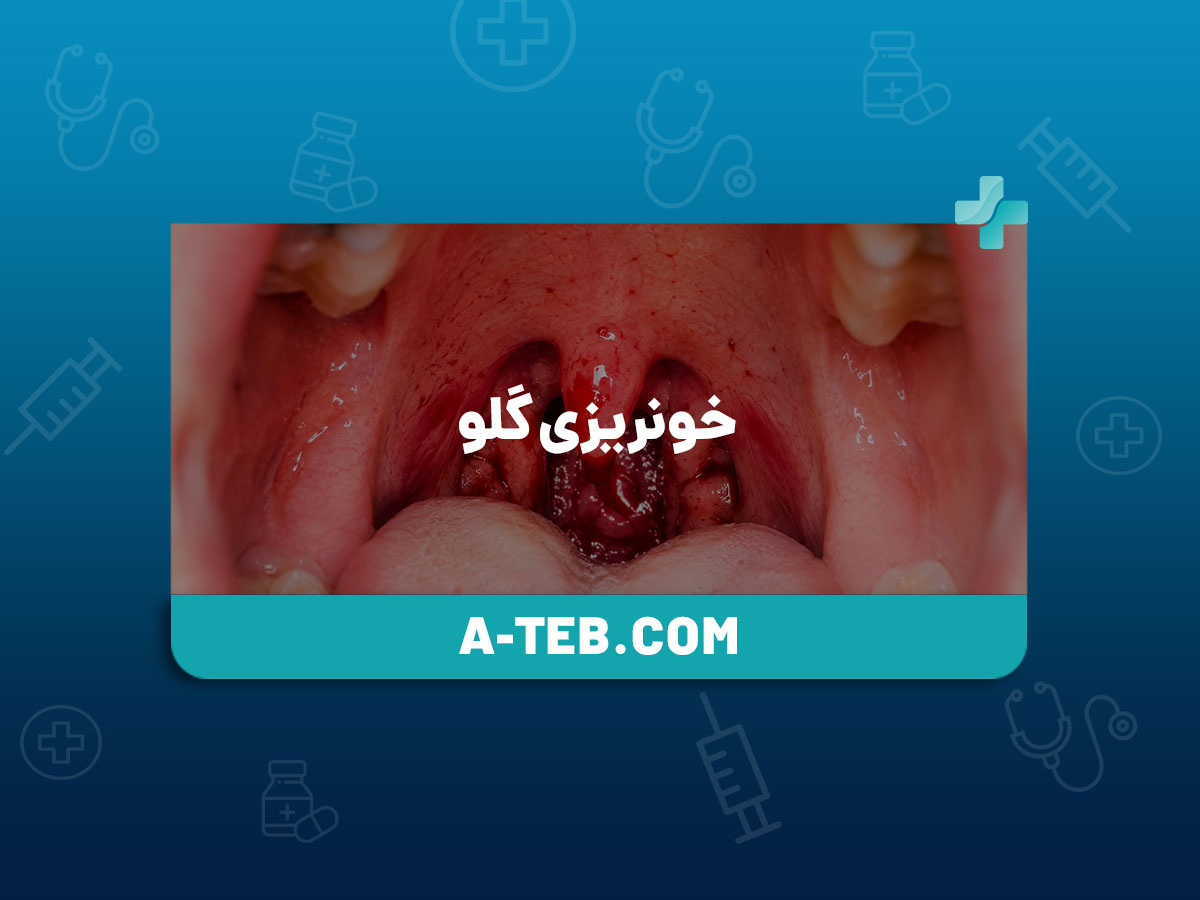 خونریزی گلو