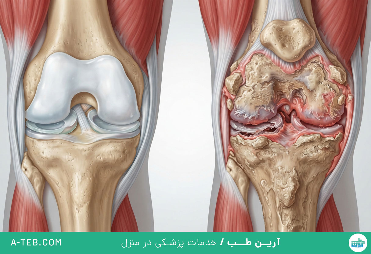 آرتروز زانو