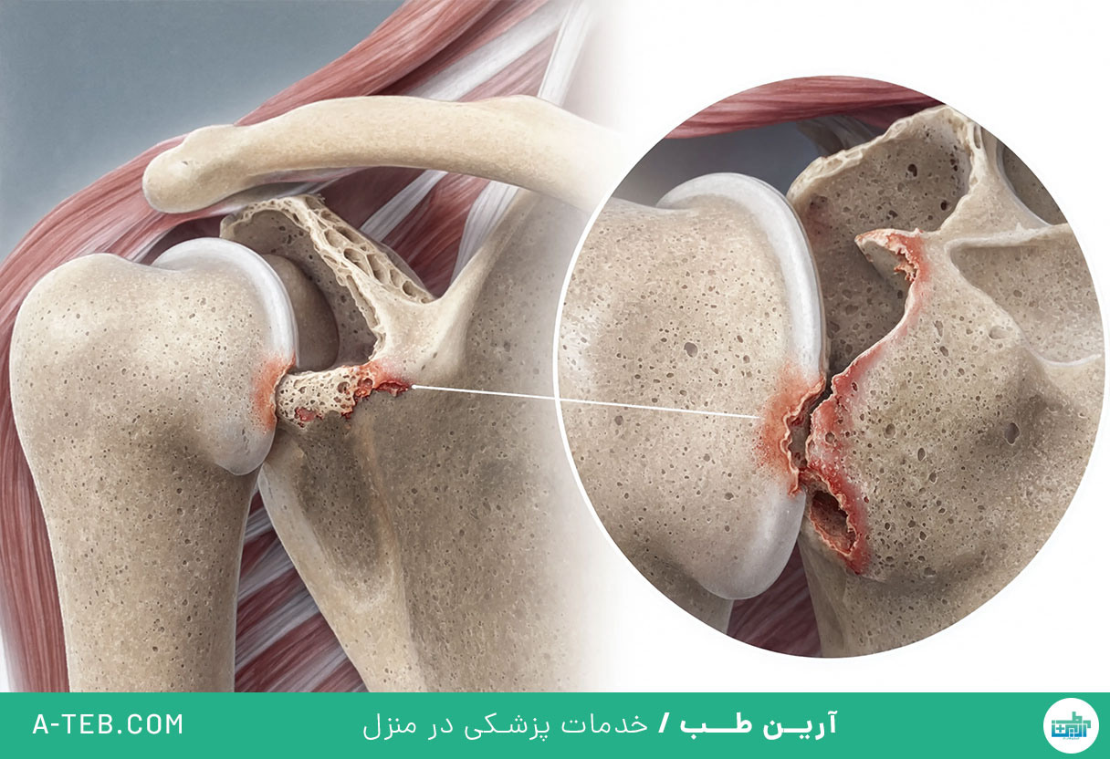 آرتروز شانه