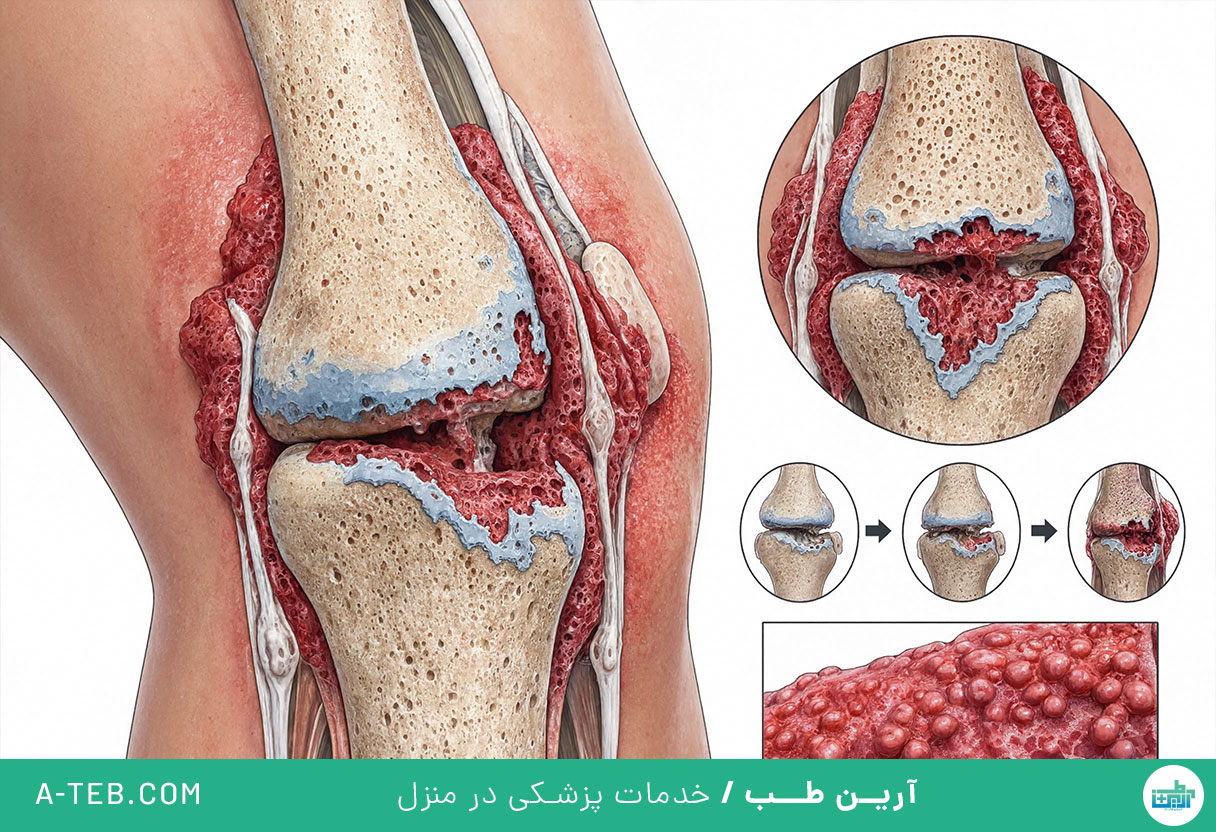روماتیسم مفصلی
