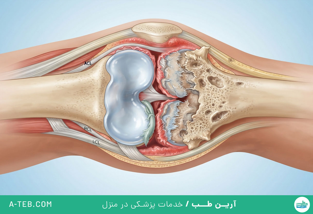 آرتروز زانو