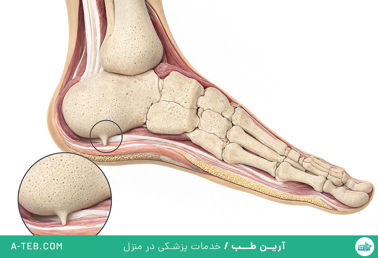 خار استخوانی