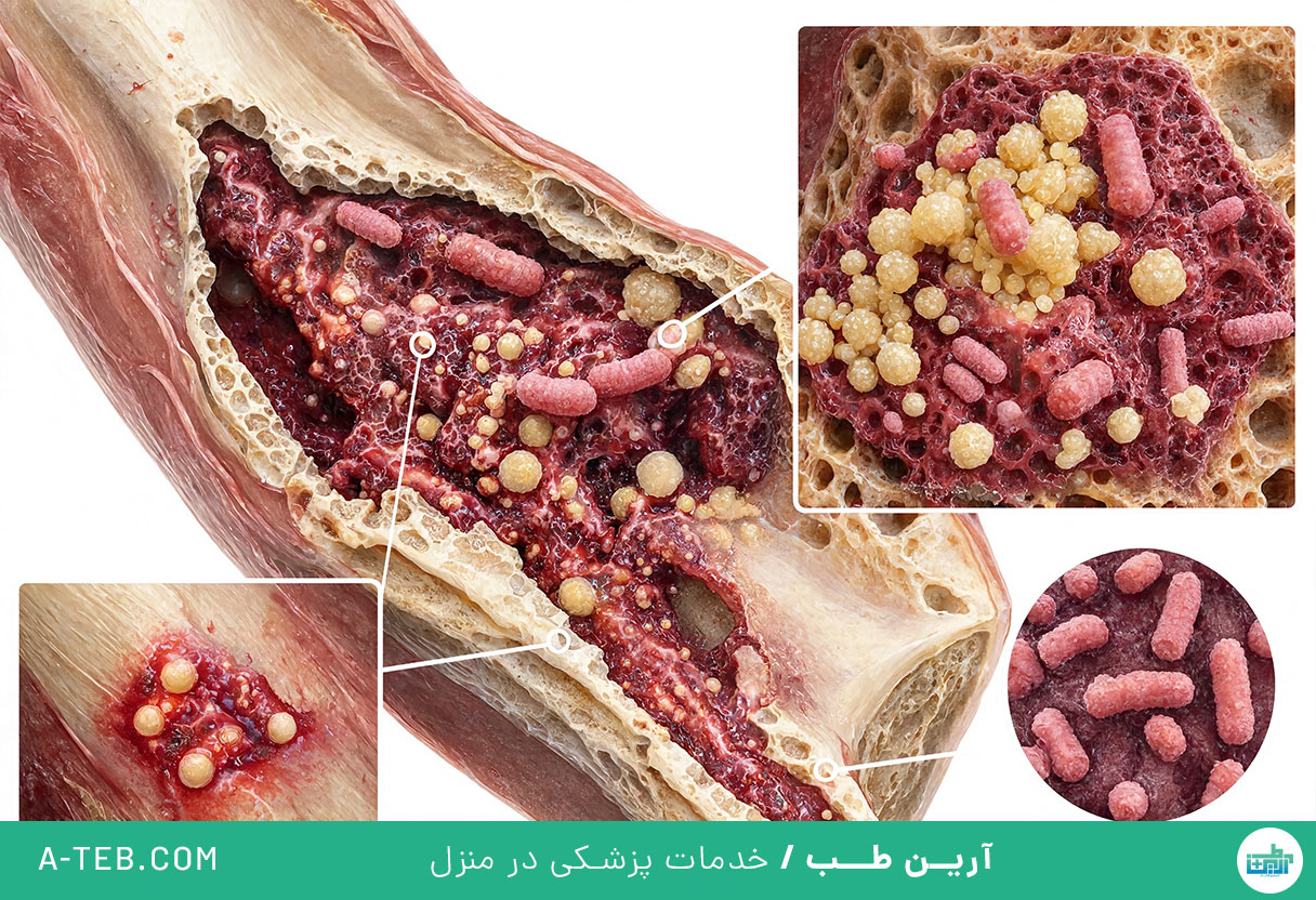 عفونت استخوان