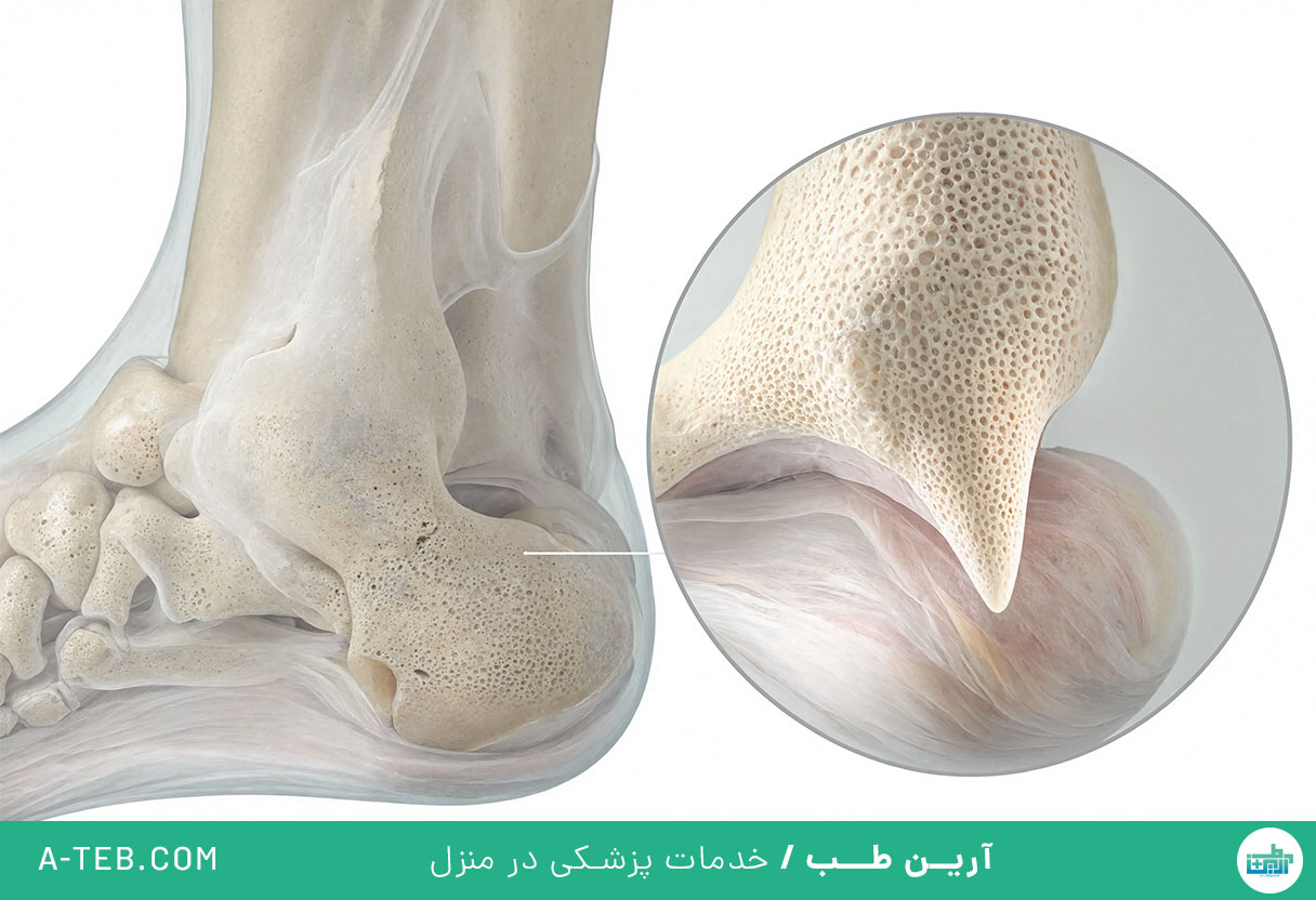 خار استخوانی