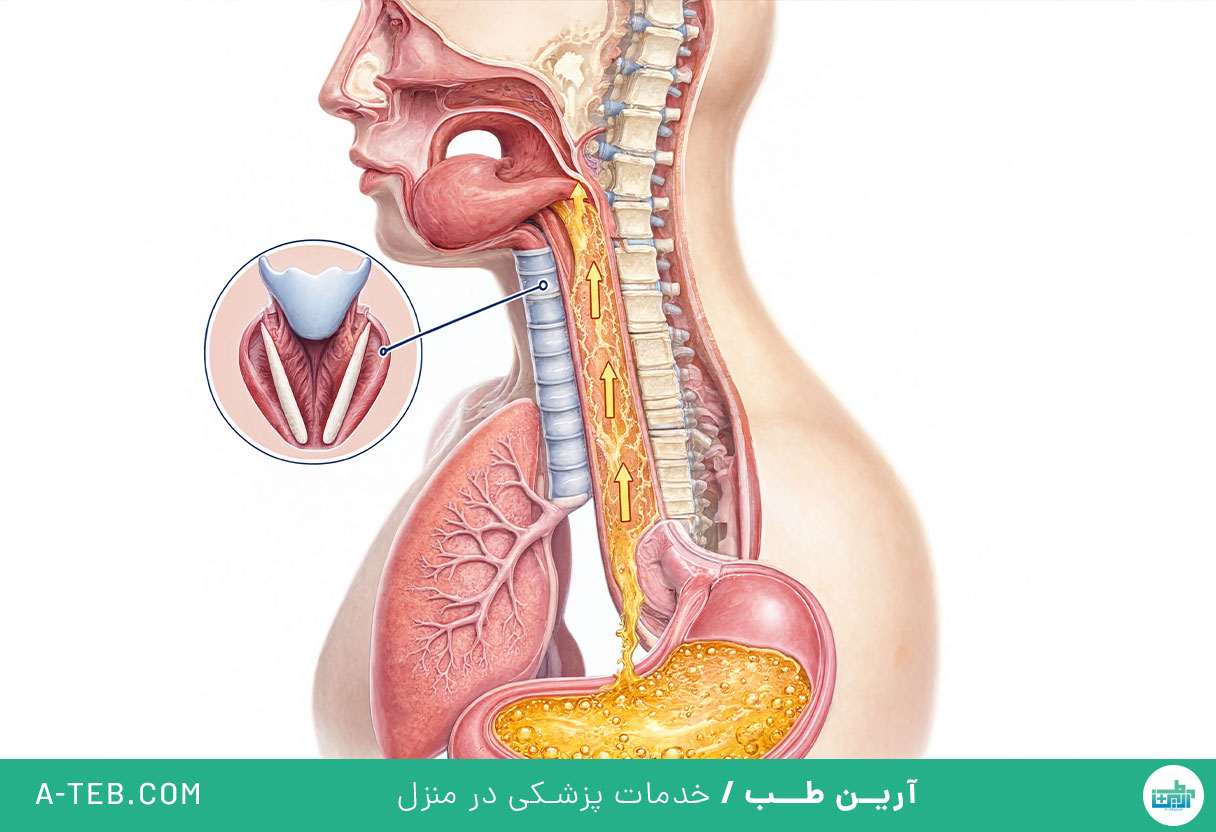 رفلاکس حنجره