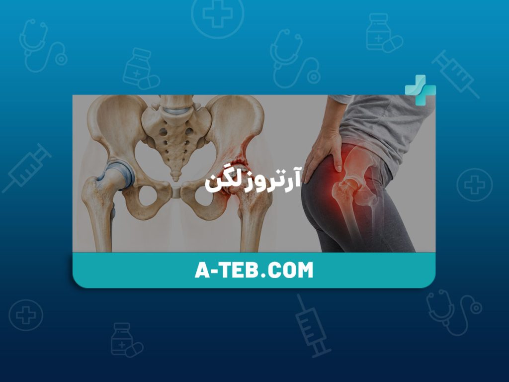 آرتروز لگن