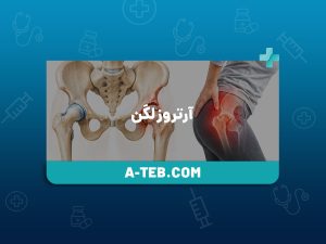 آرتروز لگن