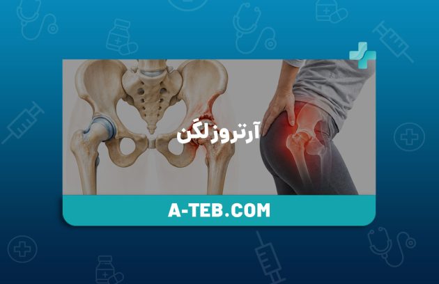 آرتروز لگن