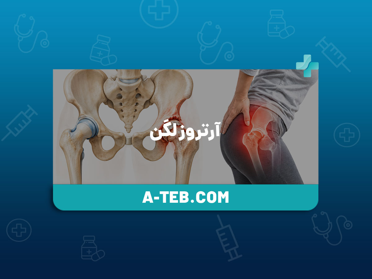 آرتروز لگن