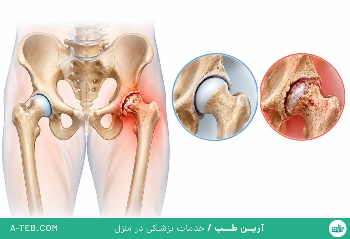 آرتروز لگن