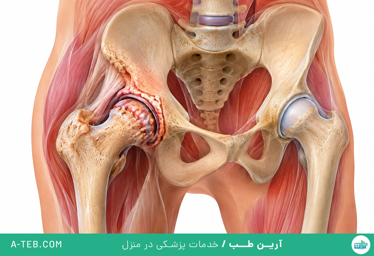 آرتروز لگن