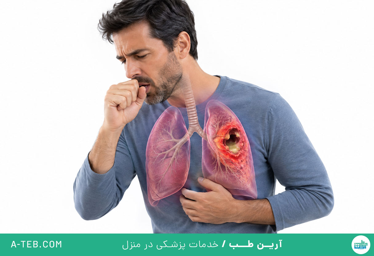 آبسه ریه