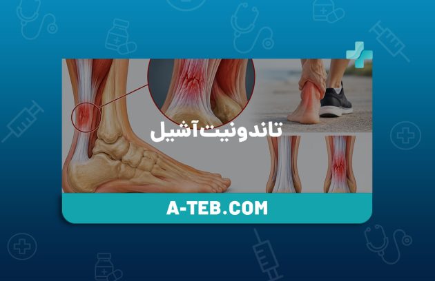 تاندونیت آشیل