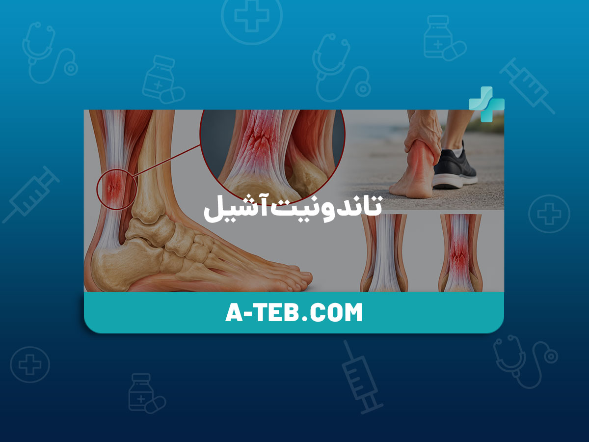 تاندونیت آشیل
