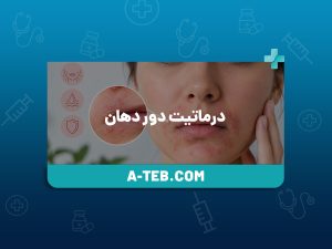 درماتیت دور دهان