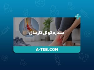 سندرم تونل تارسال