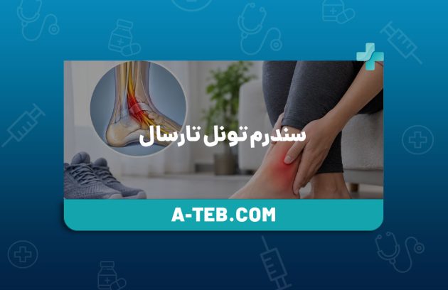 سندرم تونل تارسال