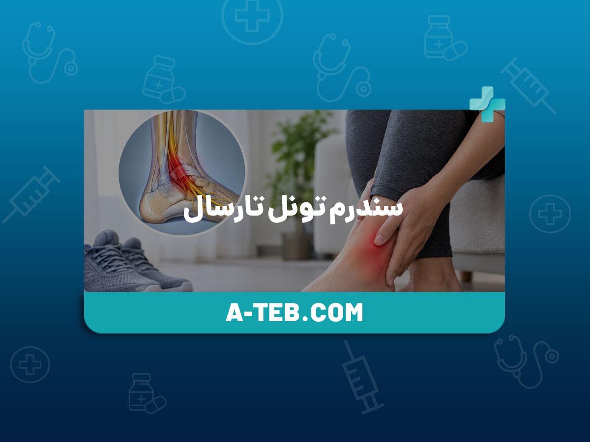 سندرم تونل تارسال