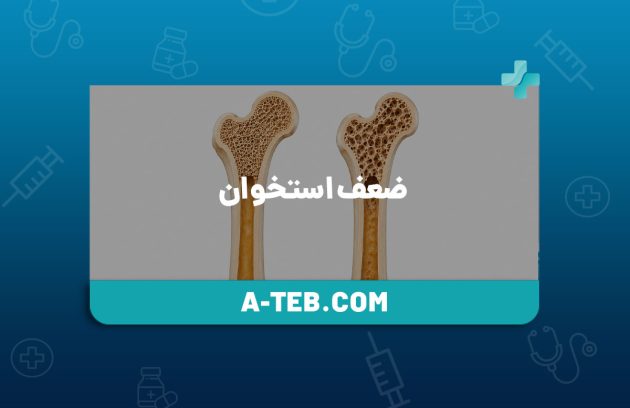 ضعف استخوان