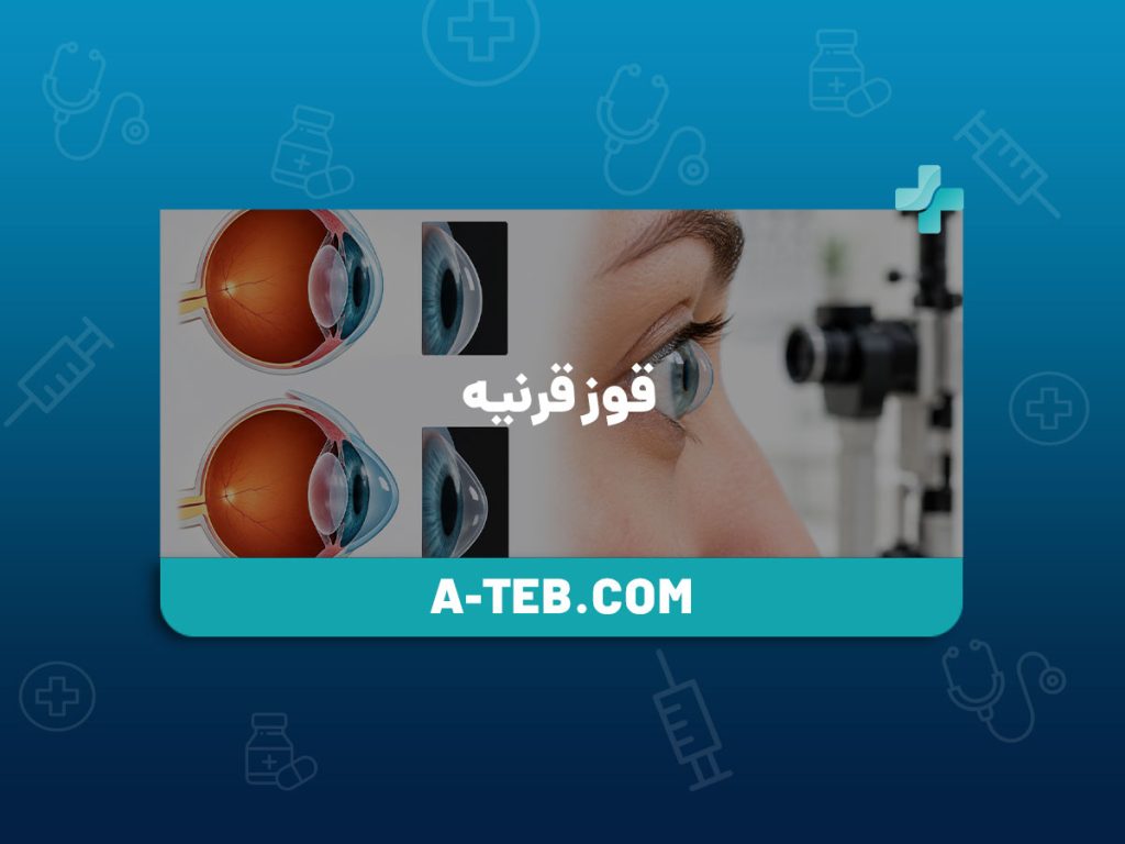 قوز قرنیه