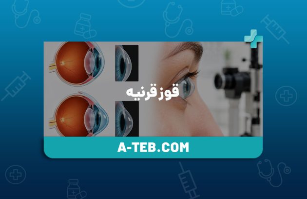 قوز قرنیه
