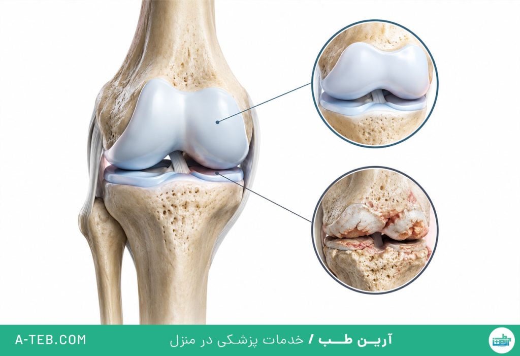 ساییدگی مفاصل