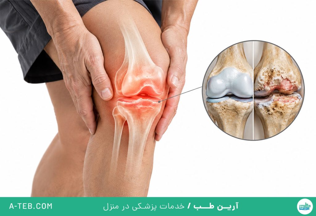 ساییدگی مفاصل
